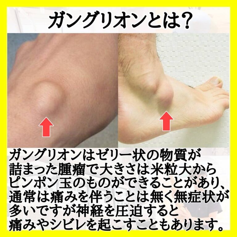 ガングリオンとは？ - 無痛整体・鍼灸治 …