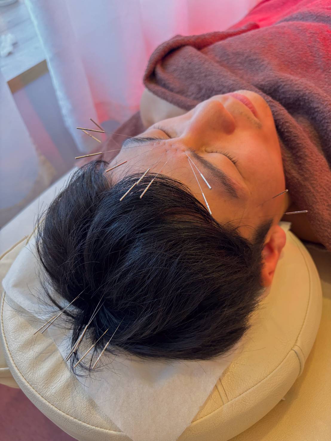 自律神経や目の疲れに対する鍼治療