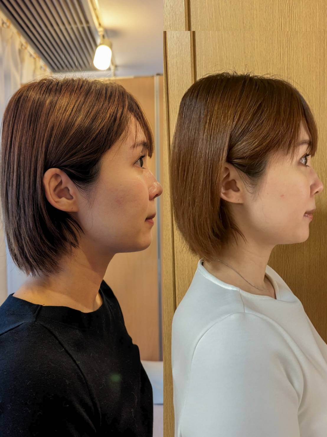 ルート治療による鬼美容鍼でフェイスラインがスッキリ！ たるみや小顔にも効果的！