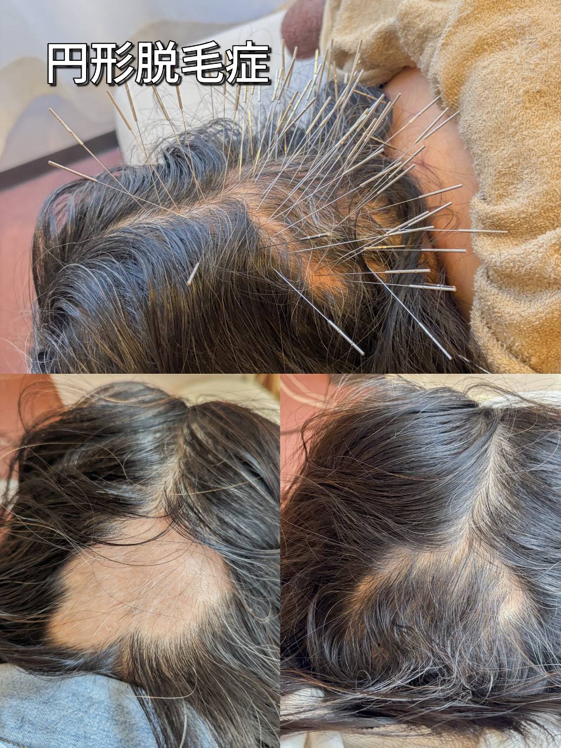 円形脱毛症の鍼治療