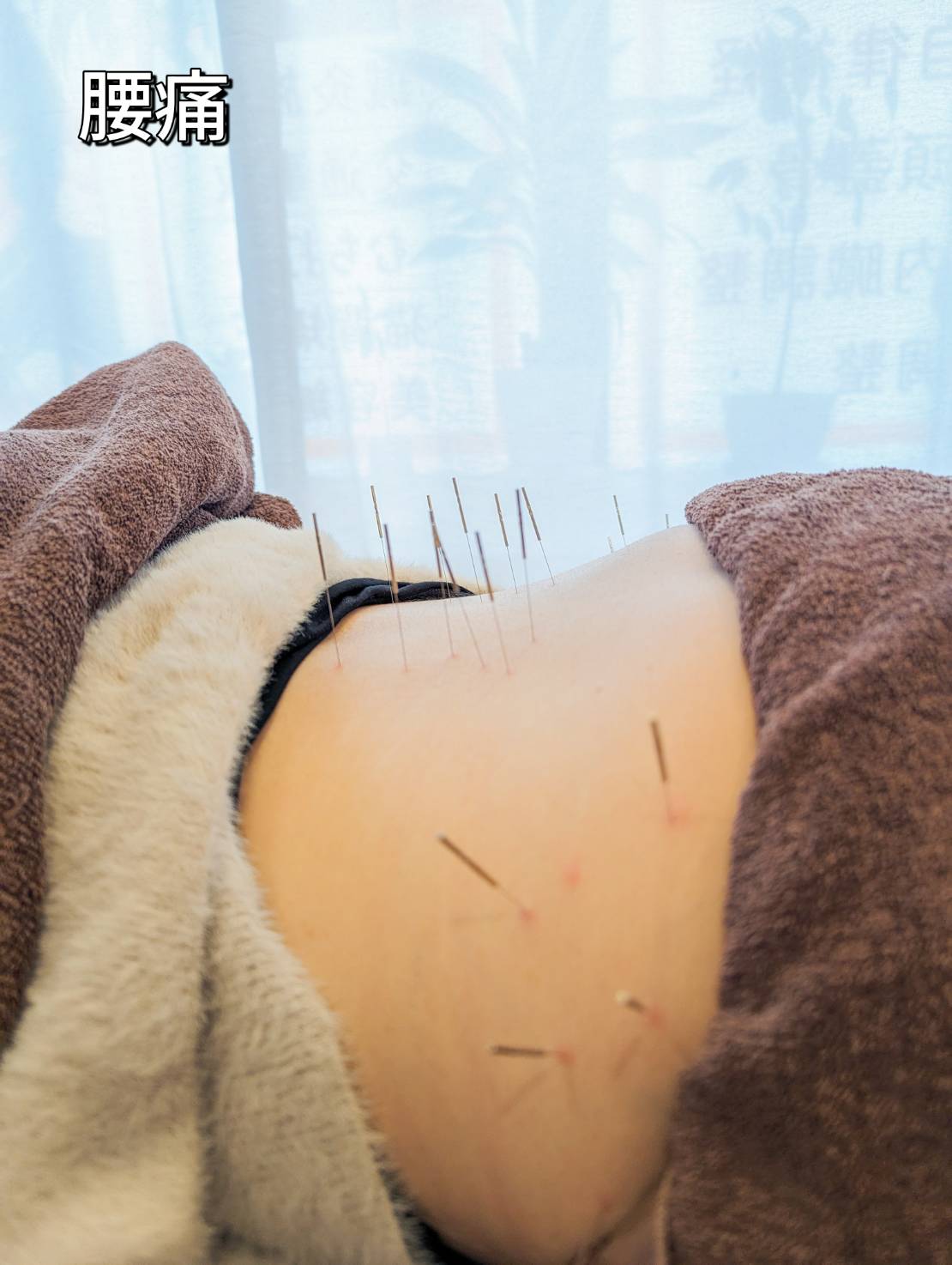 長堀橋で行う腰痛の鍼治療