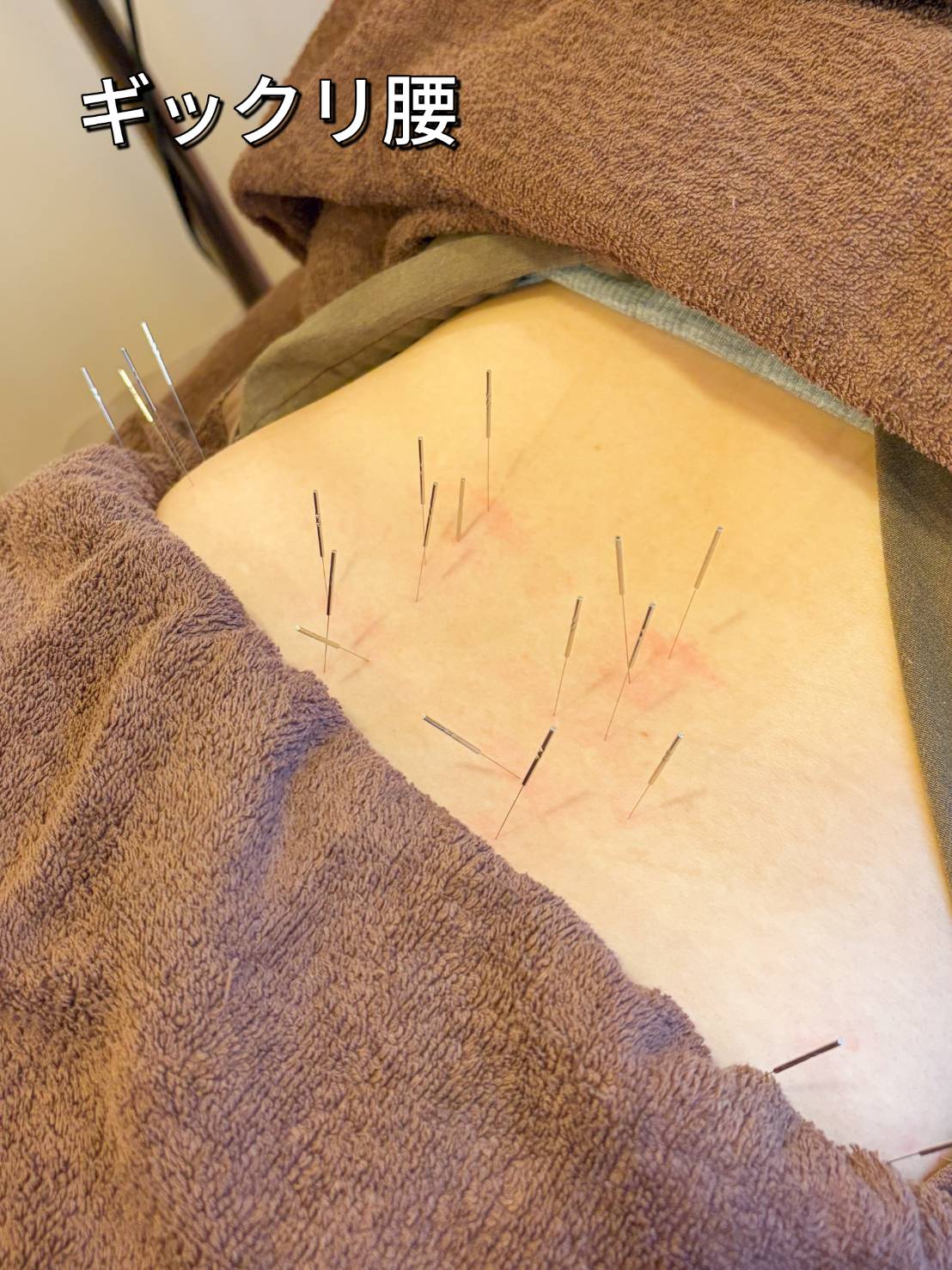 ギックリ腰の鍼治療