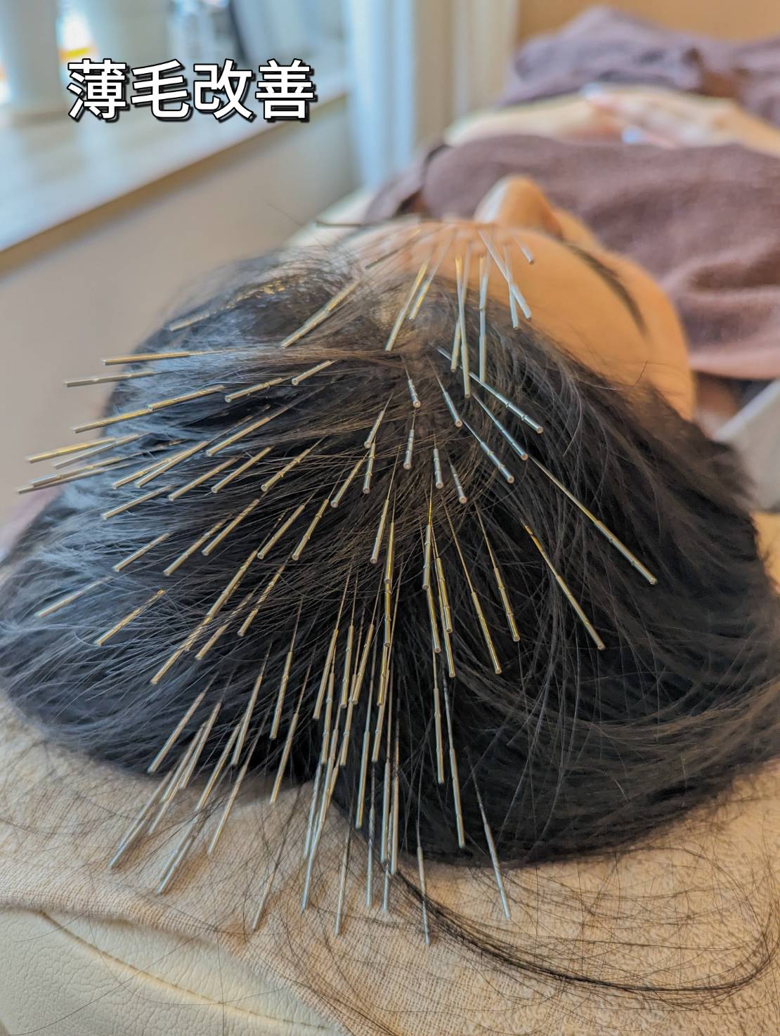 薄毛改善の鍼治療(ルート治療)