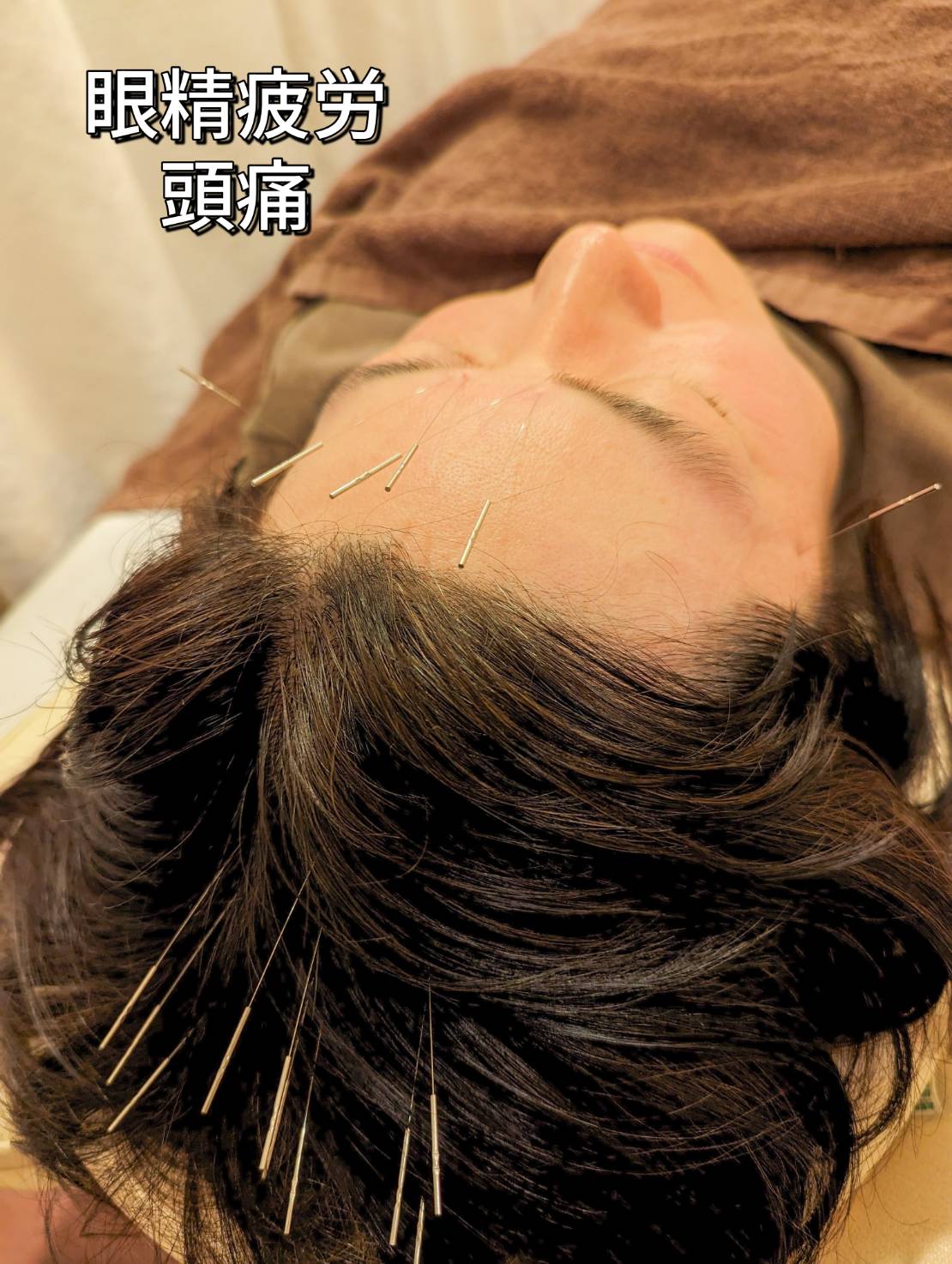 心斎橋の鍼治療で眼精疲労・頭痛を改善
