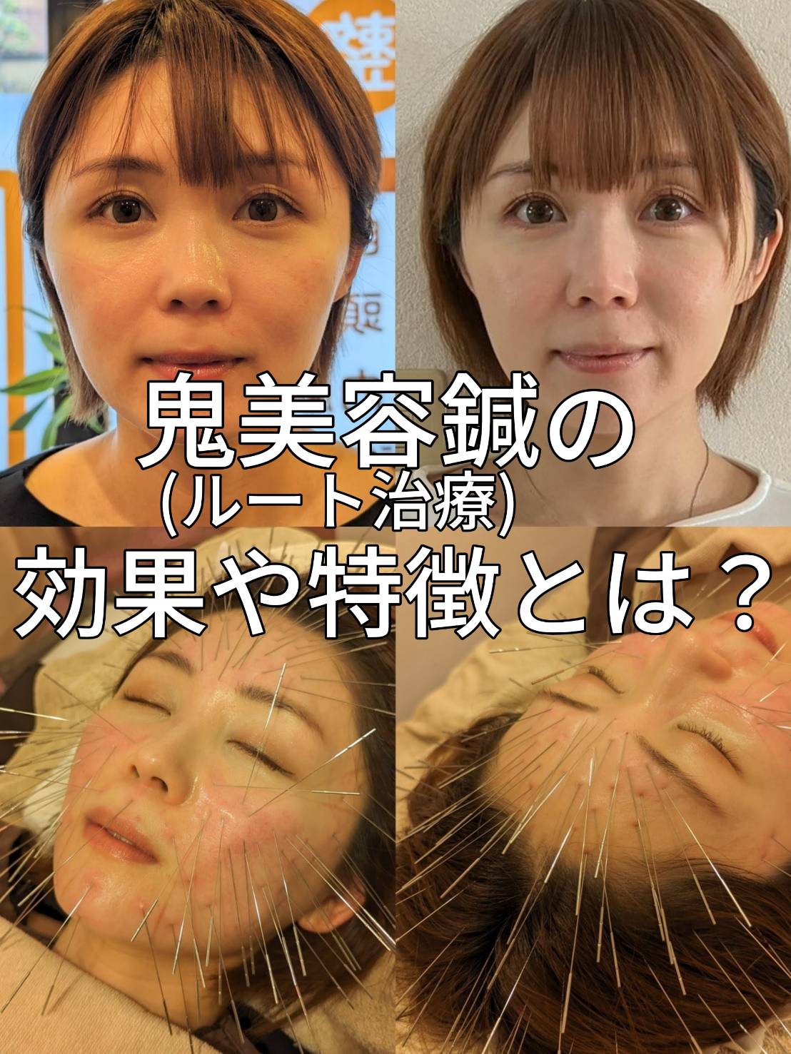 鬼美容鍼（ルート治療）の効果や特徴とは？心斎橋や長堀橋で受けれる鬼美容鍼の効果と特徴を解説！