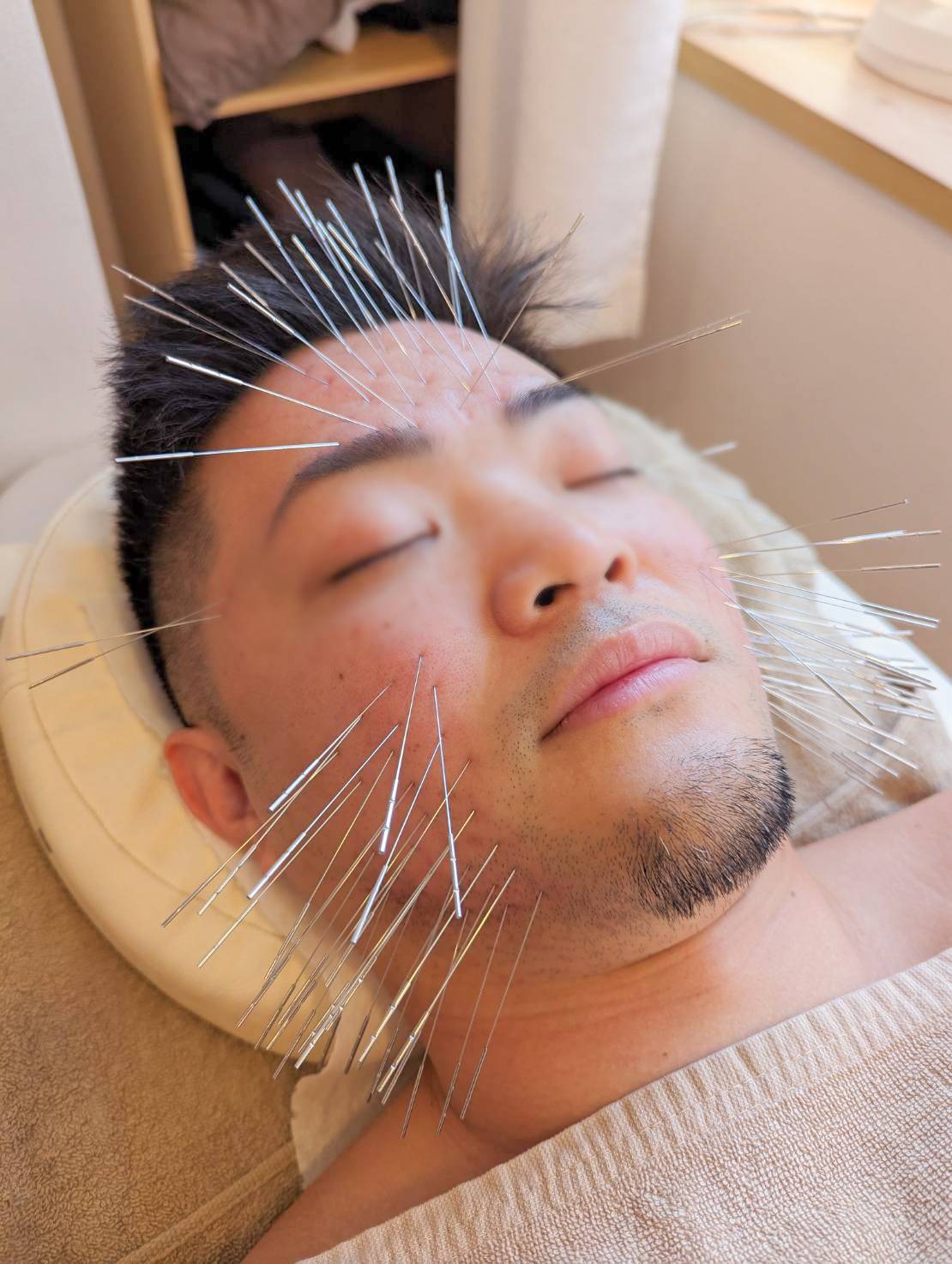 男性が美容鍼を受けるお悩みは食いしばりによるエラの張り、目の疲れやまぶたの重さ、顔のむくみやたるみ、肌荒れやニキビ跡など様々です