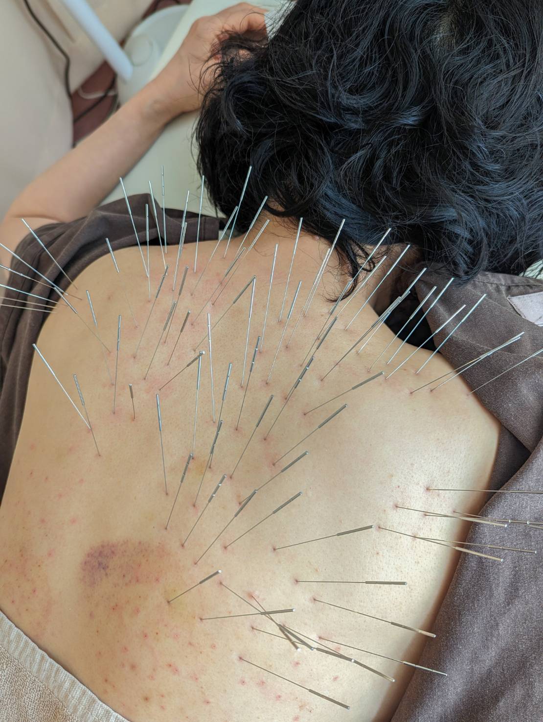 線維筋痛症の方に対するルート治療