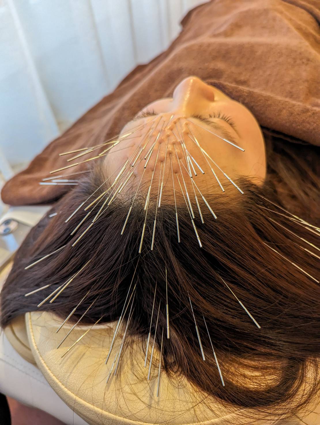 ルート治療や鬼美容鍼によるおでこや頭部への刺鍼は美容面だけでなく眼精疲労やドライアイ、頭痛や不眠や睡眠障害の改善にも効果的です！