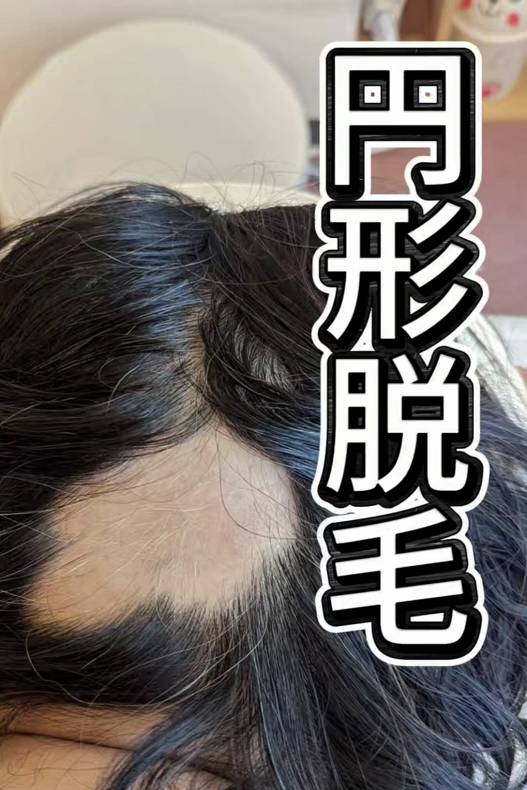 ルート治療による円形脱毛症に対する鍼灸治療