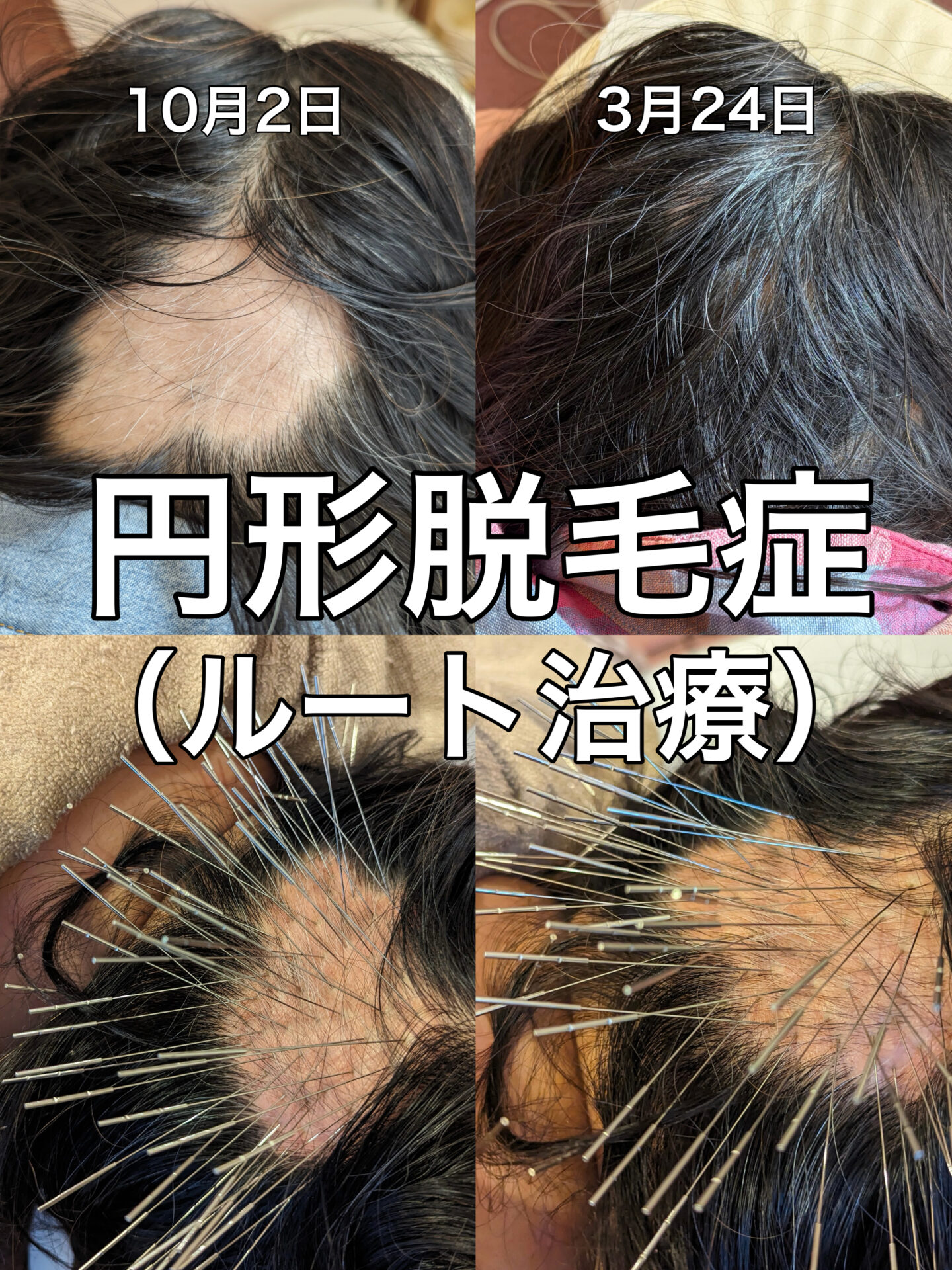 大阪市は東心斎橋でおこなっているルート治療による円形脱毛症に対する施術