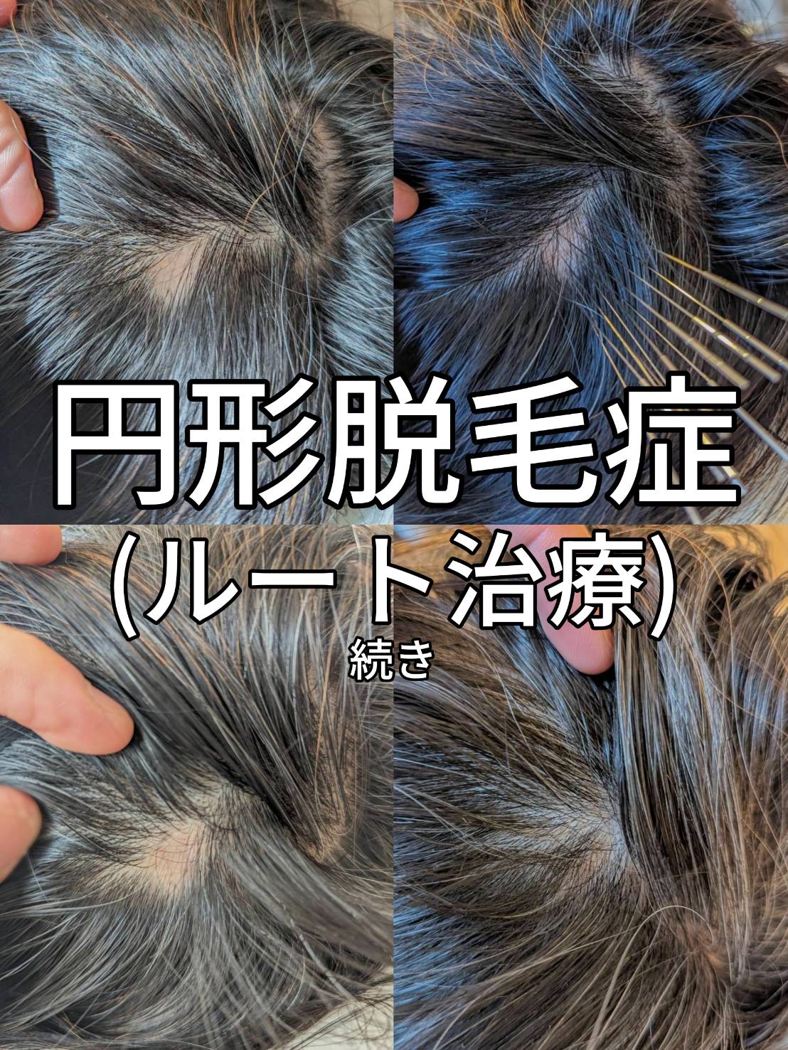 小さい円形脱毛症と鍼治療~大阪で行うルート治療による経過と変化②~