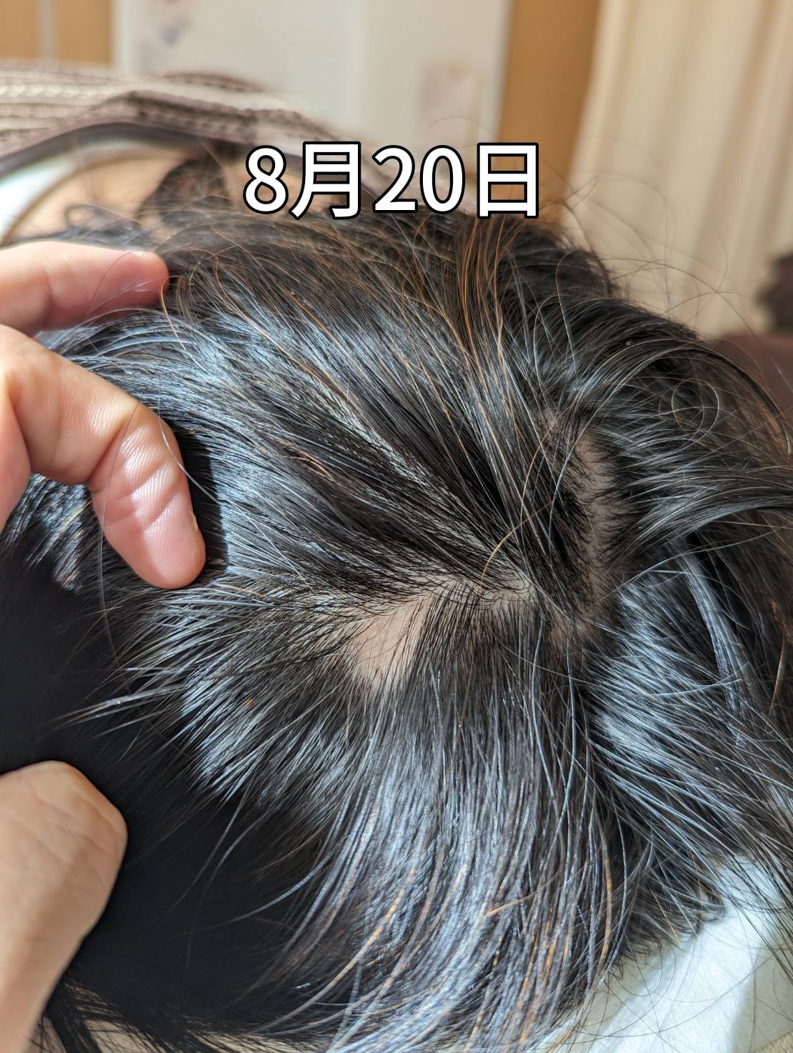 円形脱毛症を行う前の画像(大阪市のルート治療を行う鍼灸院)
