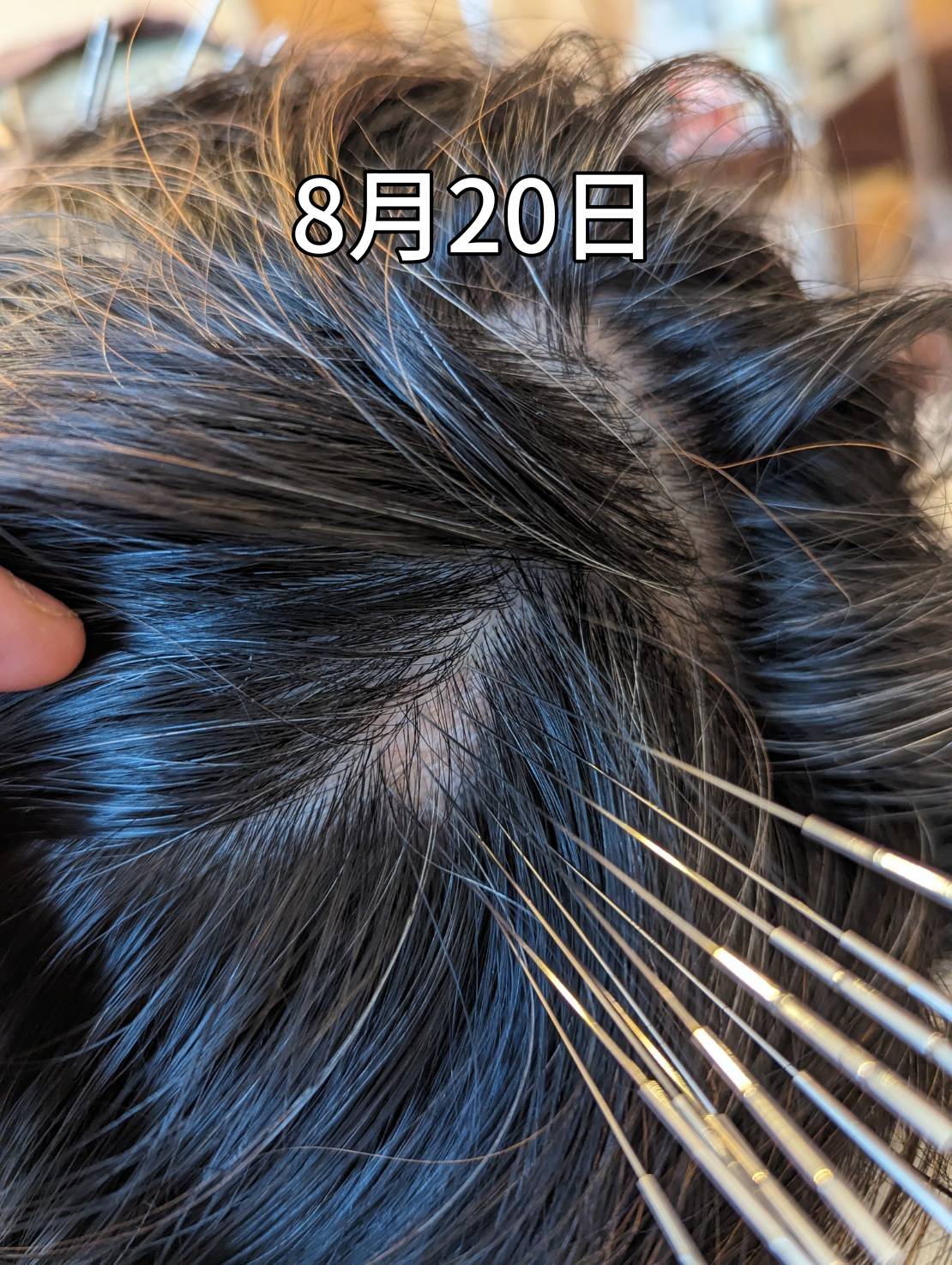 小さい円形脱毛症にルート治療を行っている画像