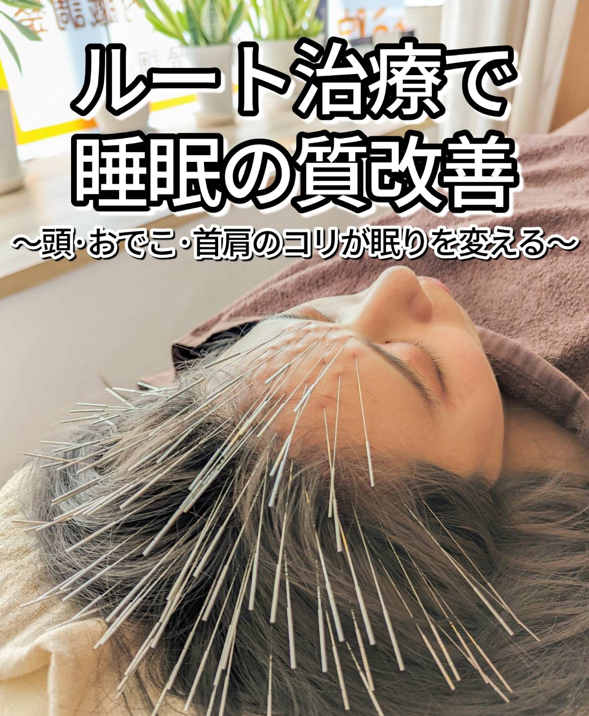 ルート治療で睡眠の質を改善 ～頭・おでこ・首肩のコリが眠りを変える～大阪市のルート治療は東心斎橋整骨院へ