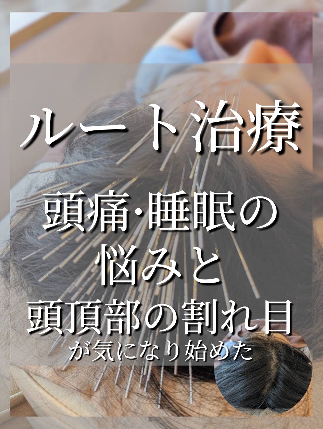 頭痛・睡眠の質の低下・頭頂部の薄毛(割れ目)が気になる｜ルート治療で身体全体を整える